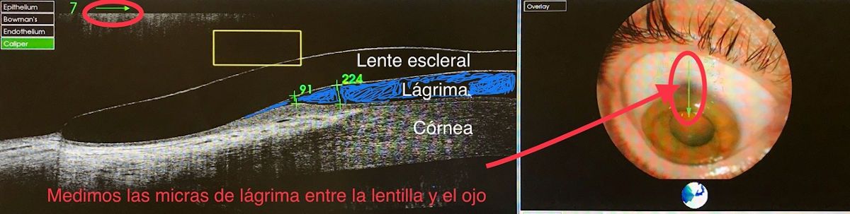 Lentes de contacto RPG · Esclerales · Híbridas