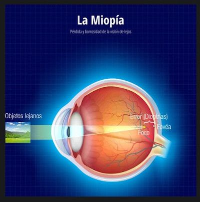 control de la miopía